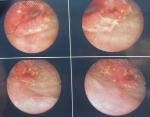 Before Treatment