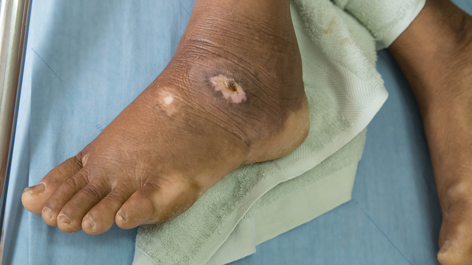 Diabetes-Foot Diabetes Foot